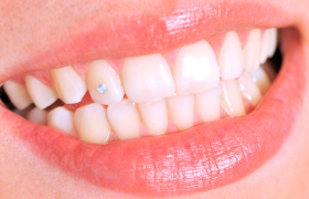 Zahnschmuck und Piercings